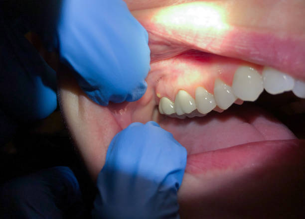 Best Emergency Wisdom Teeth Removal in Kincheloe, MI